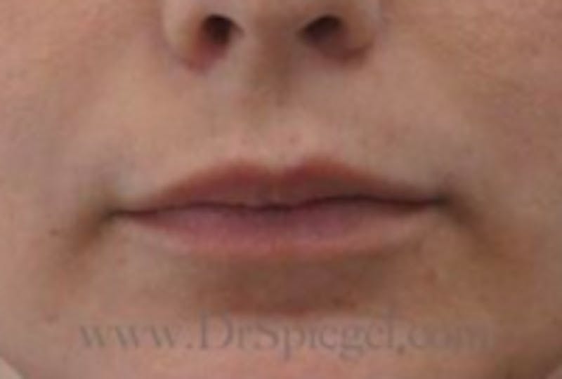 Lip Lift Before & After Gallery - Patient 157140113 - Image 2