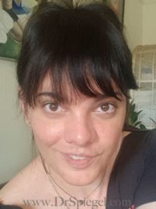 FFS Before & After Gallery - Patient 157140115 - Image 4