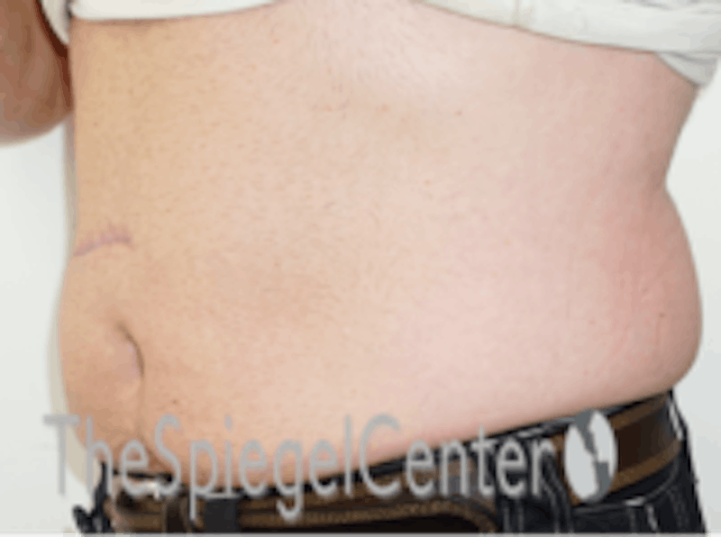 Bodytite Before & After Gallery - Patient 157140120 - Image 5