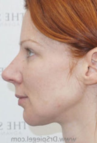 Botox / Dysport / Jeuveau / Xeomin Before & After Gallery - Patient 157140118 - Image 6