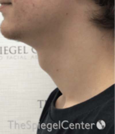 Trachea Shave Before & After Gallery - Patient 157140121 - Image 1