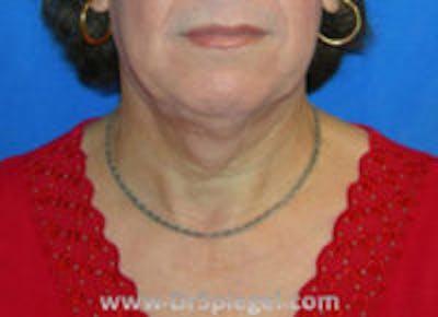 Mandible Contouring Before & After Gallery - Patient 157140123 - Image 1