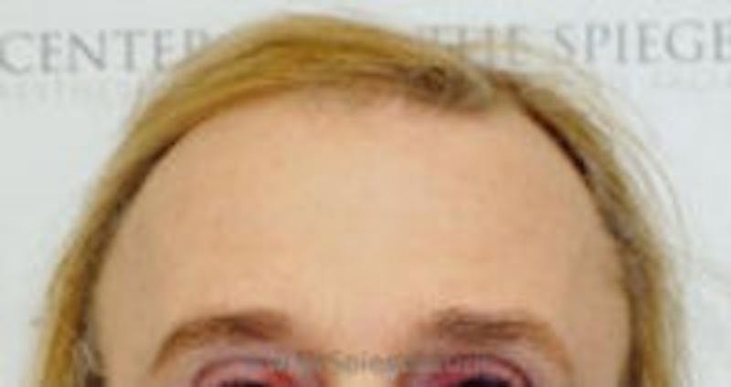 Forehead Contouring Before & After Gallery - Patient 157140119 - Image 2