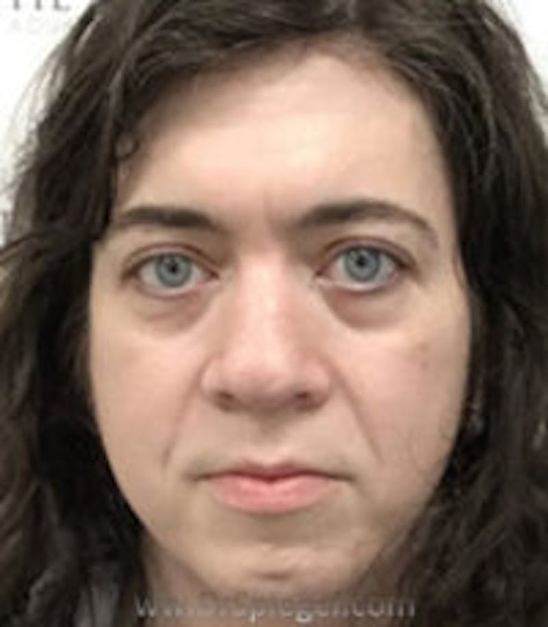 FFS Before & After Gallery - Patient 157140129 - Image 1
