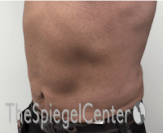 Bodytite Before & After Gallery - Patient 157140120 - Image 6