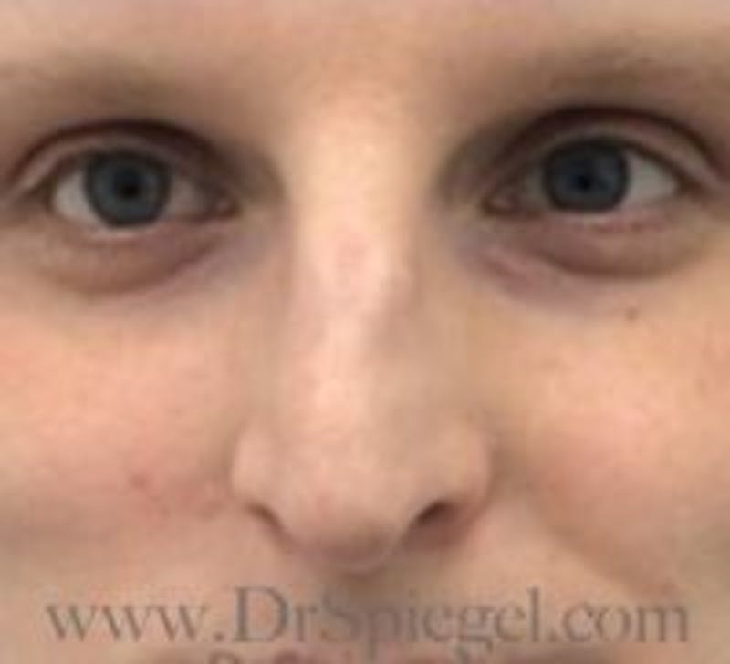 Rhinoplasty Before & After Gallery - Patient 157140130 - Image 3
