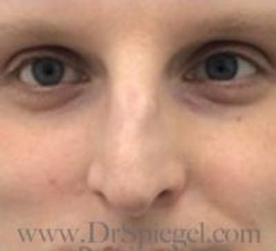 Rhinoplasty Before & After Gallery - Patient 157140130 - Image 3