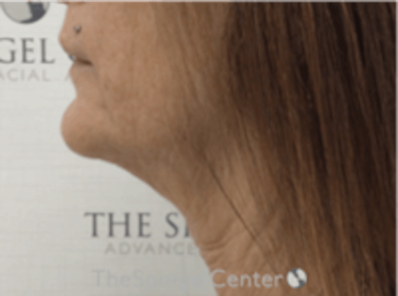 Neck Lift Before & After Gallery - Patient 157140124 - Image 1