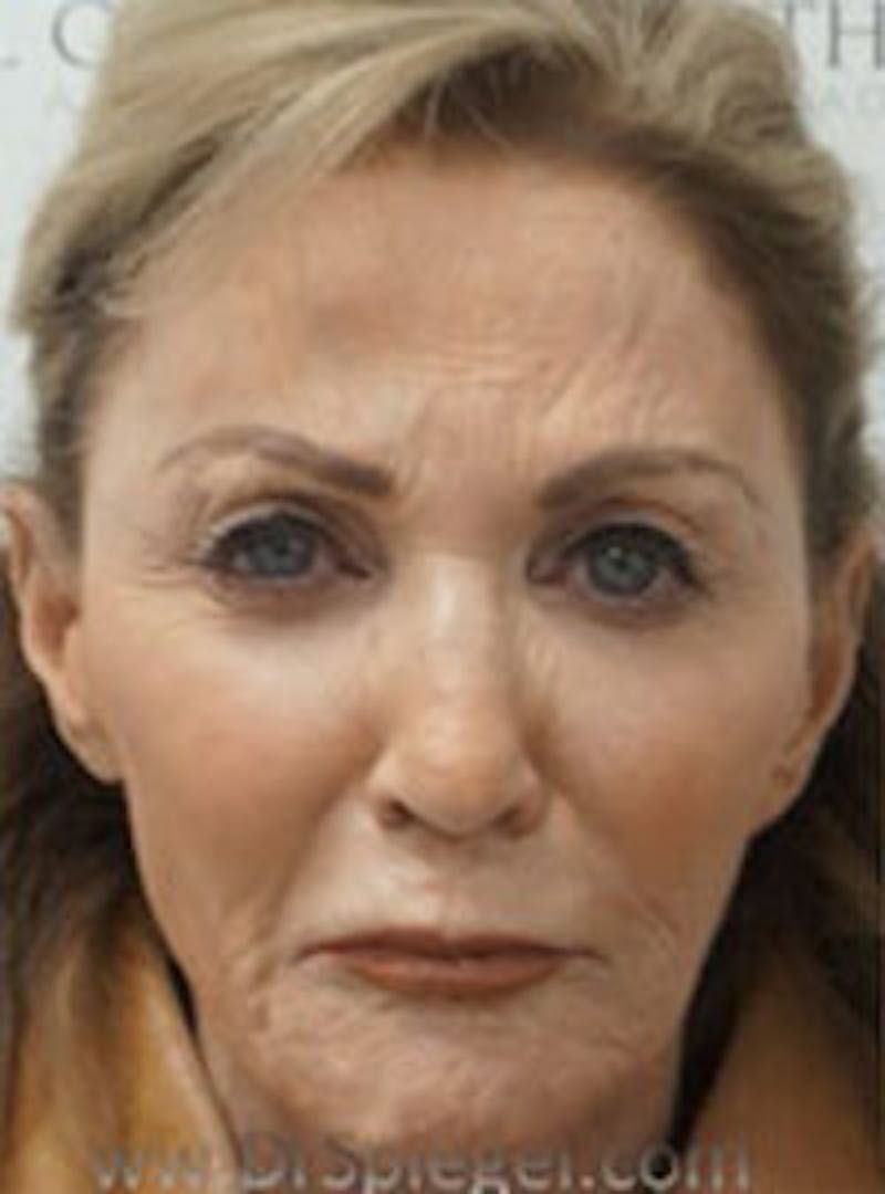 Botox / Dysport / Jeuveau / Xeomin Before & After Gallery - Patient 157140135 - Image 1
