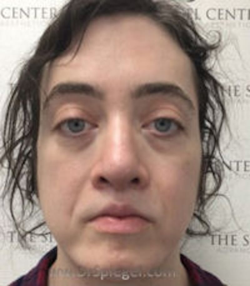 FFS Before & After Gallery - Patient 157140129 - Image 2