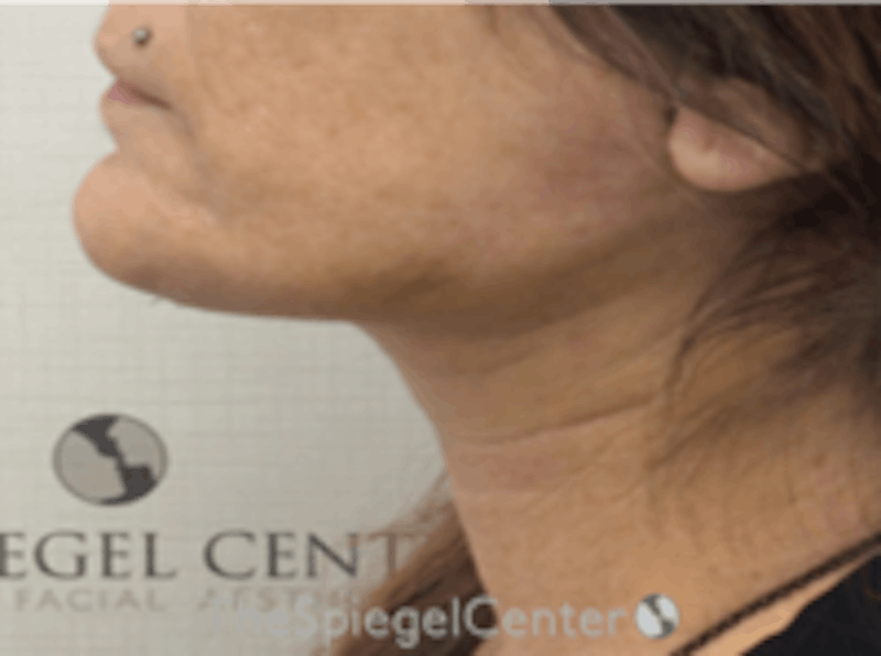 Neck Lift Before & After Gallery - Patient 157140124 - Image 2