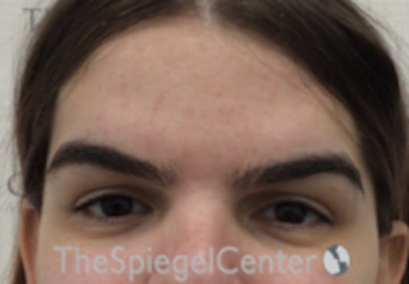 Forehead Contouring Before & After Gallery - Patient 157140132 - Image 1