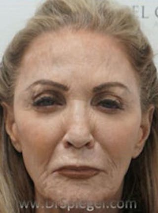 Botox / Dysport / Jeuveau / Xeomin Before & After Gallery - Patient 157140135 - Image 2