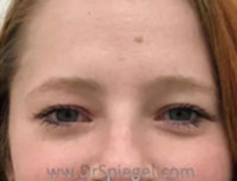 Non-Surgical Brow Lift