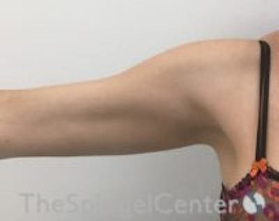 Arm Lift Before & After Gallery - Patient 214675 - Image 1