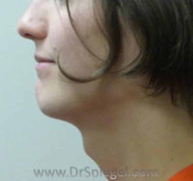 Trachea Shave Before & After Gallery - Patient 157140126 - Image 1
