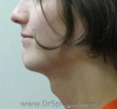 Trachea Shave Before & After Gallery - Patient 157140126 - Image 1