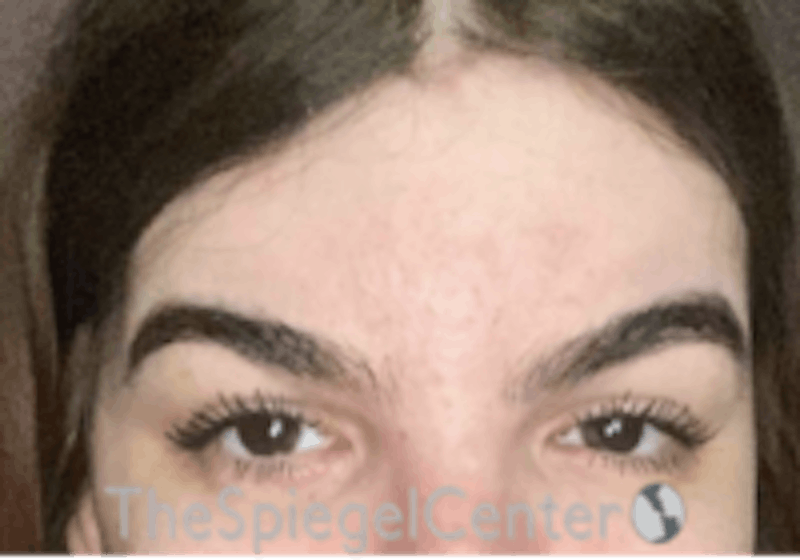 Forehead Contouring Before & After Gallery - Patient 157140132 - Image 2