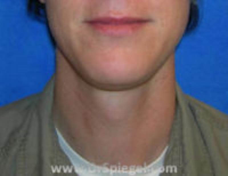 Mandible Contouring Before & After Gallery - Patient 157140128 - Image 1