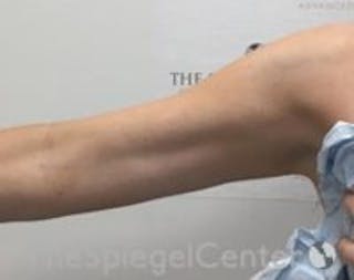 Bodytite Before & After Gallery - Patient 157140133 - Image 2