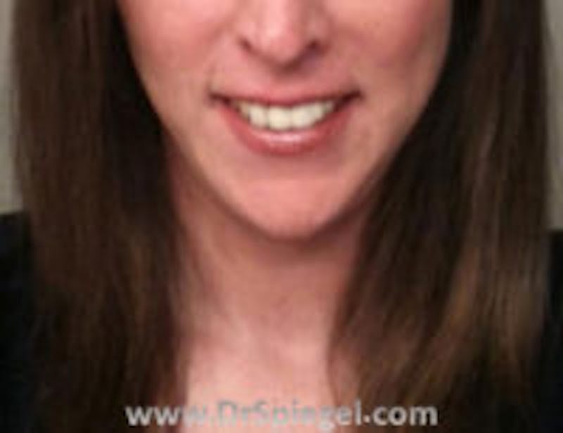 Mandible Contouring Before & After Gallery - Patient 157140128 - Image 2