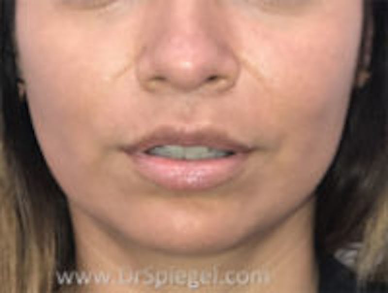 Lip Augmentation / Lip Implant / Lip Lift Before & After Gallery - Patient 157140127 - Image 2