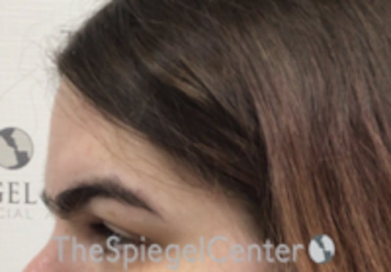 Forehead Contouring Before & After Gallery - Patient 157140132 - Image 3