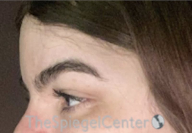 Forehead Contouring Before & After Gallery - Patient 157140132 - Image 4