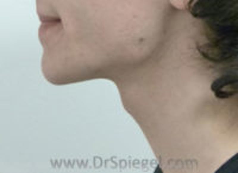 Trachea Shave Before & After Gallery - Patient 157140136 - Image 1