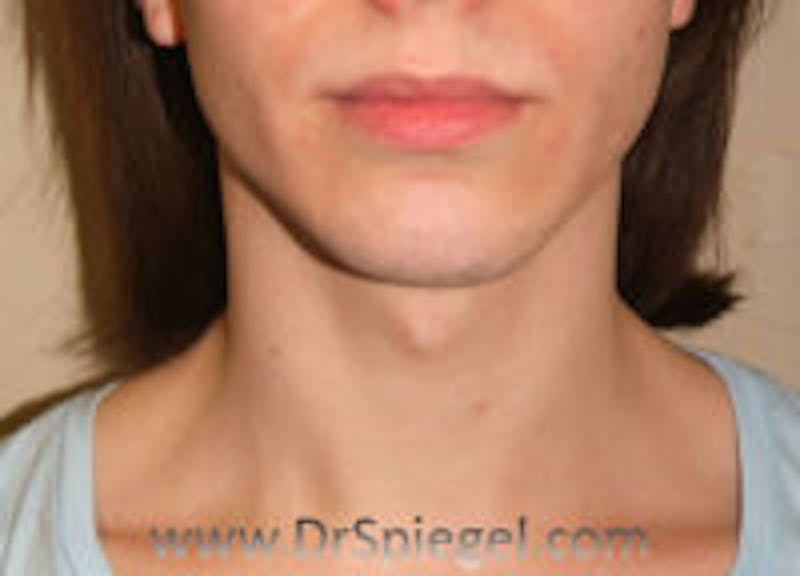 Mandible Contouring Before & After Gallery - Patient 157140138 - Image 1