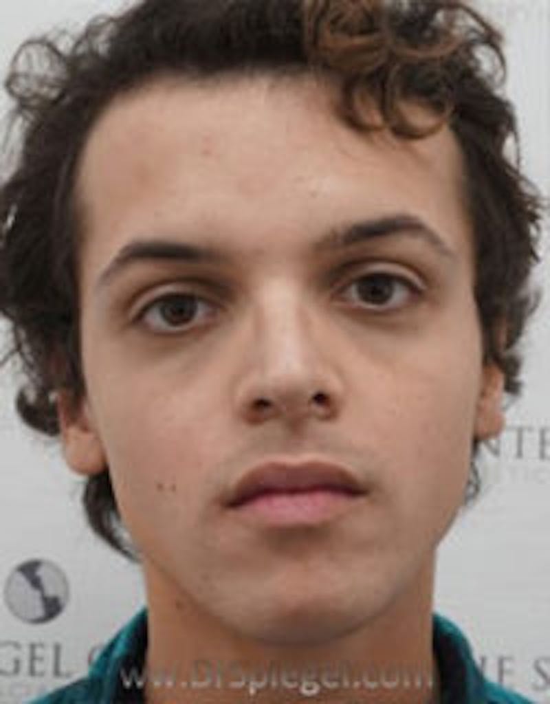 FFS Before & After Gallery - Patient 157140141 - Image 1