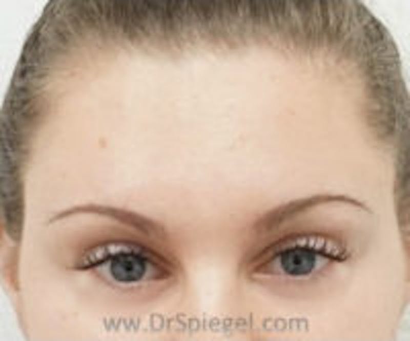 Botox Browlift Before & After Gallery - Patient 157140134 - Image 2