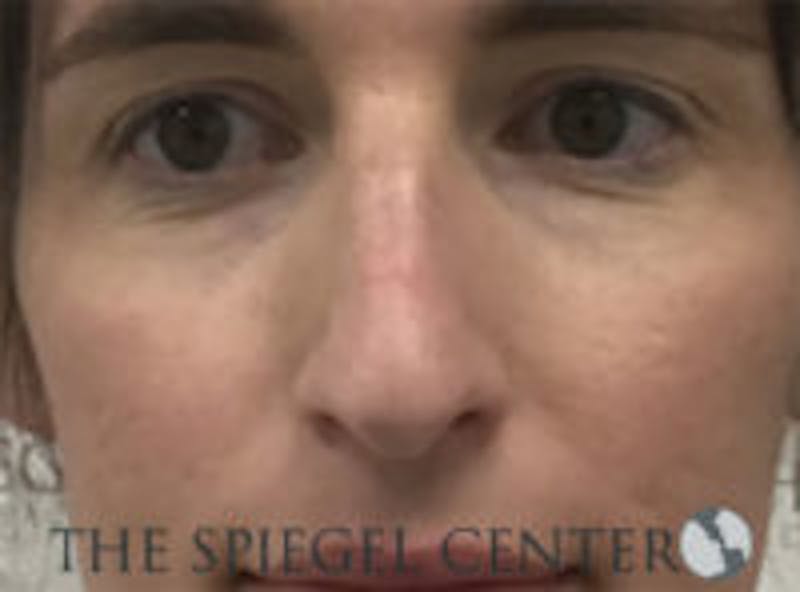 Rhinoplasty Before & After Gallery - Patient 157140142 - Image 3