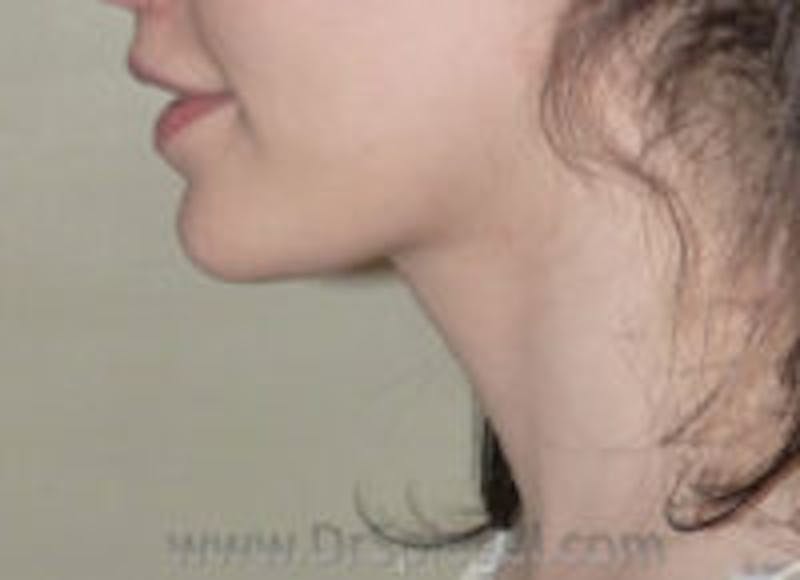 Trachea Shave Before & After Gallery - Patient 157140136 - Image 2