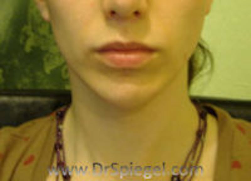 Mandible Contouring Before & After Gallery - Patient 157140138 - Image 2