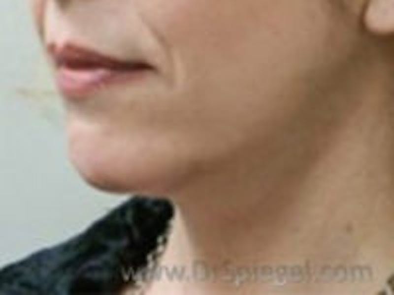 Neck Lift Before & After Gallery - Patient 157140139 - Image 2