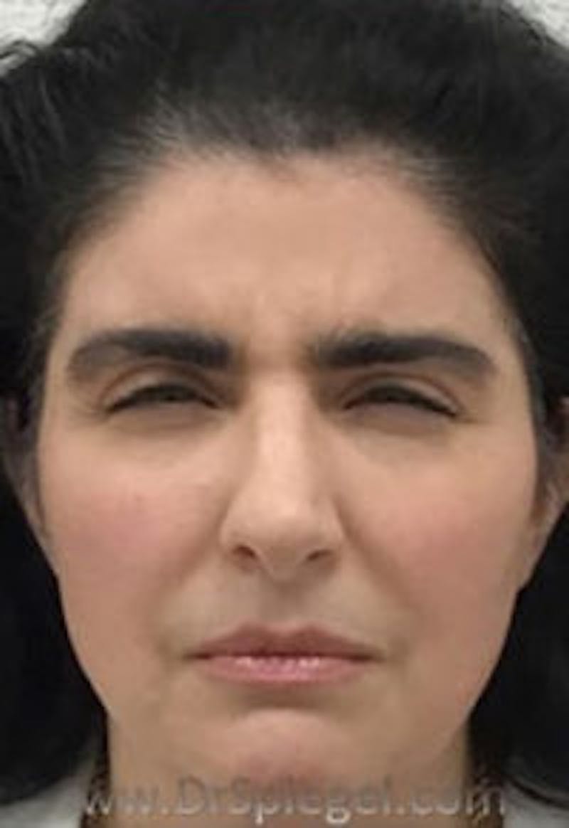 Botox / Dysport / Jeuveau / Xeomin Before & After Gallery - Patient 157140154 - Image 1