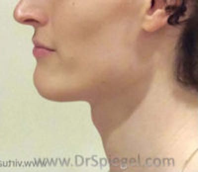 Trachea Shave Before & After Gallery - Patient 157140145 - Image 1
