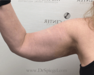 Bodytite Before & After Gallery - Patient 157140148 - Image 2