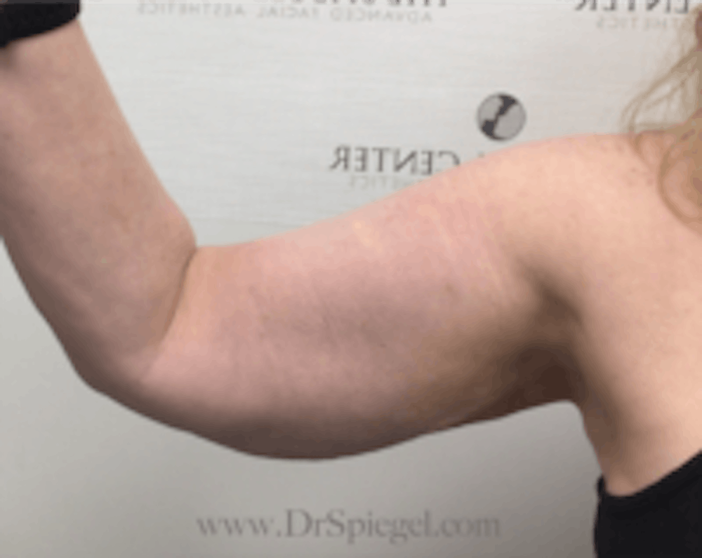 Arm Lift with Bodytite