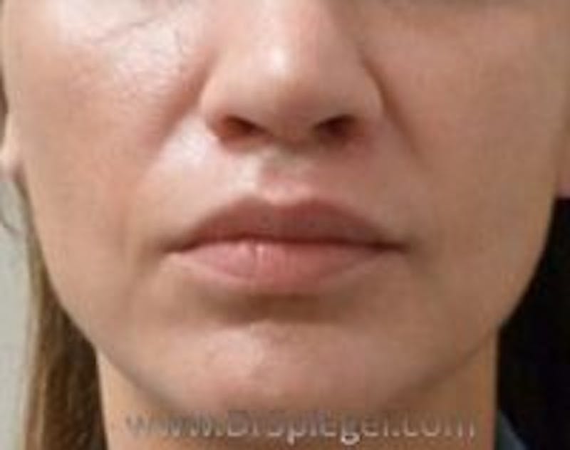 Lip Lift Before & After Gallery - Patient 157140143 - Image 2