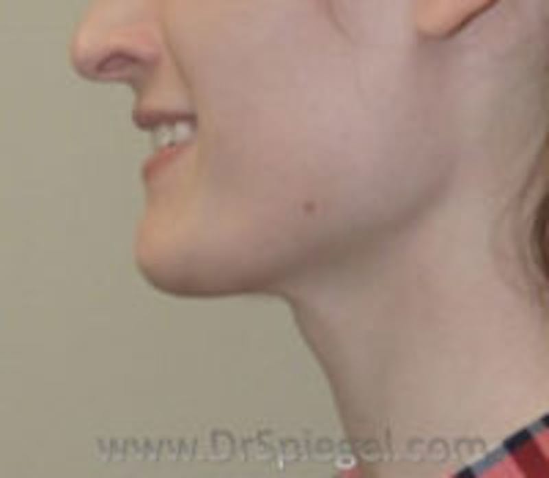 Trachea Shave Before & After Gallery - Patient 157140145 - Image 2