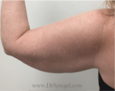 Arm Lift Before & After Gallery - Patient 350388 - Image 3