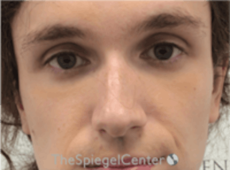 Rhinoplasty Before & After Gallery - Patient 157140158 - Image 3