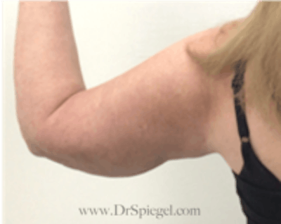 Arm Lift Before & After Gallery - Patient 350388 - Image 4