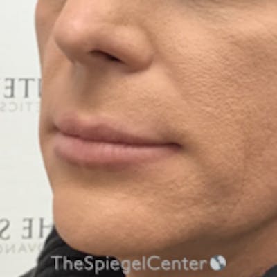Lip Lift Before & After Gallery - Patient 157140153 - Image 1