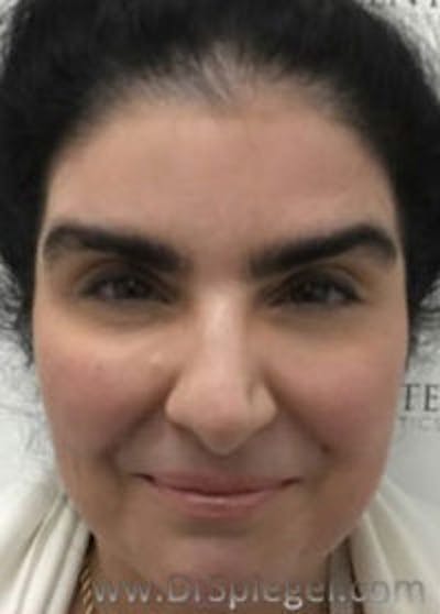 Botox / Dysport / Jeuveau / Xeomin Before & After Gallery - Patient 157140154 - Image 4