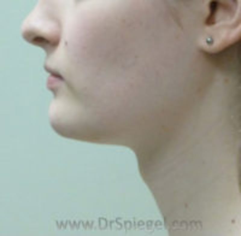 Trachea Shave Before & After Gallery - Patient 157140150 - Image 1