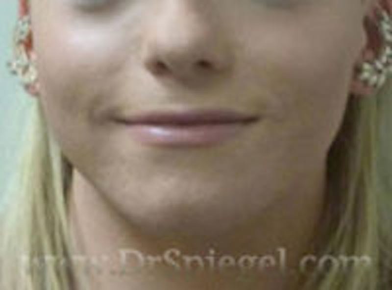 Mandible Contouring Before & After Gallery - Patient 157140151 - Image 1