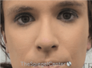 Rhinoplasty Before & After Gallery - Patient 157140158 - Image 4